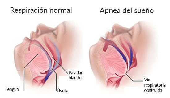 Apnea del sueño en la montaña